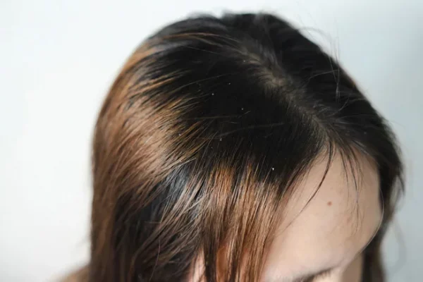 5 tips to solve the problem of greasy hair Say goodbye to dirty hair.