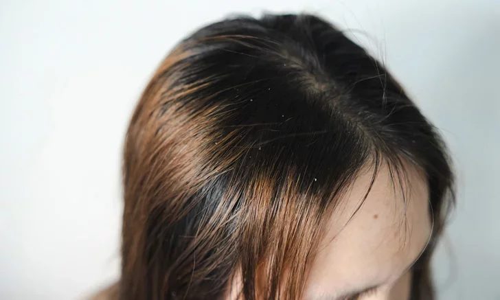 5 tips to solve the problem of greasy hair Say goodbye to dirty hair.